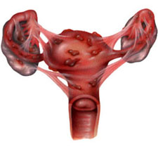 endometriosis_and_adhesions